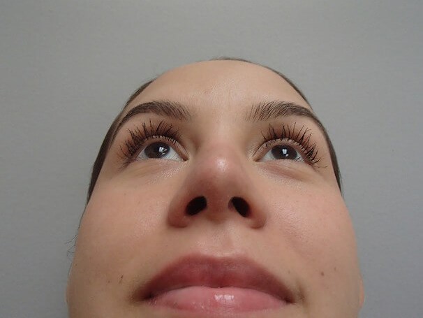 Rhinoplasty (Nose Job) After