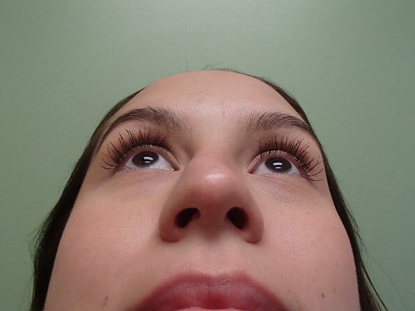 Rhinoplasty (Nose Job) Before