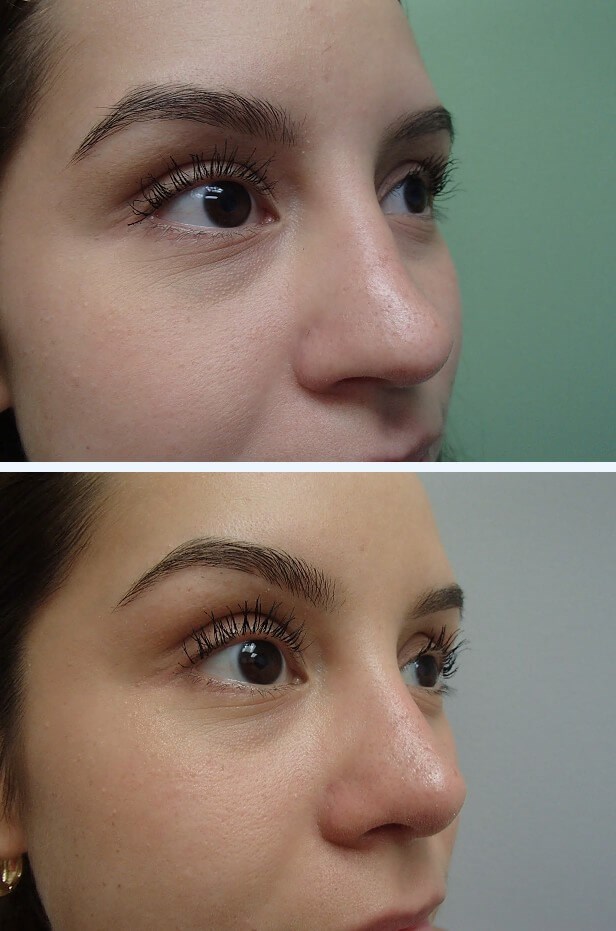 Rhinoplasty (Nose Job) Before
