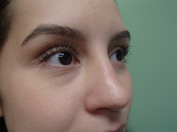 Rhinoplasty (Nose Job) Before