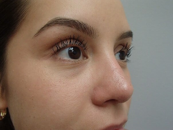 Rhinoplasty (Nose Job) After
