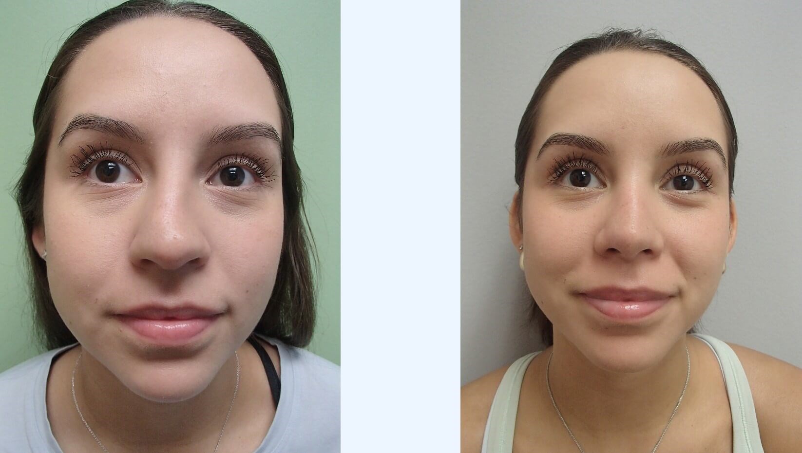 Rhinoplasty (Nose Job) Before