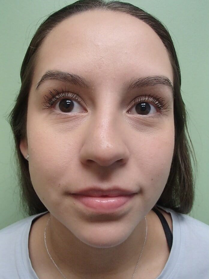 Rhinoplasty (Nose Job) Before