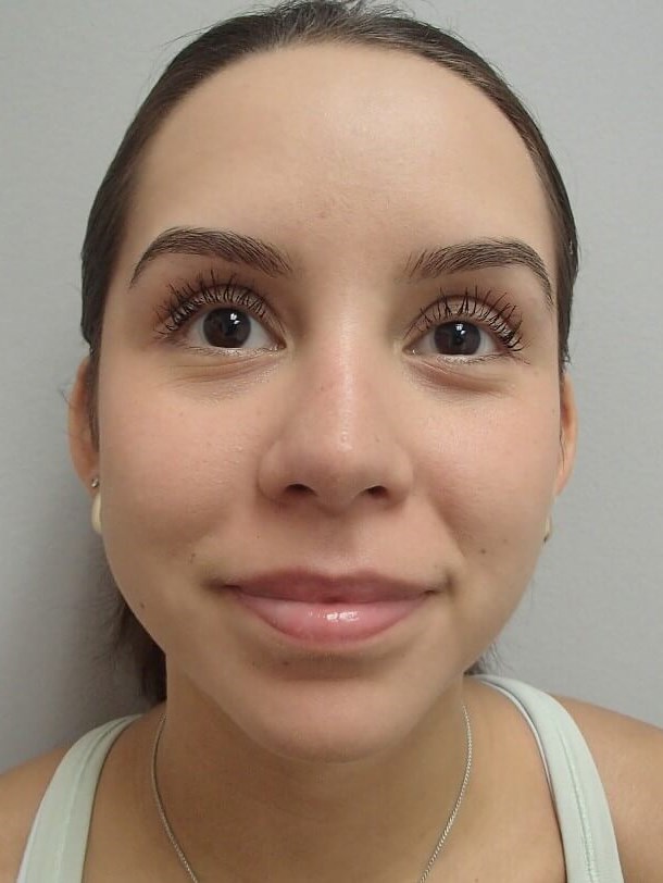 Rhinoplasty (Nose Job) After