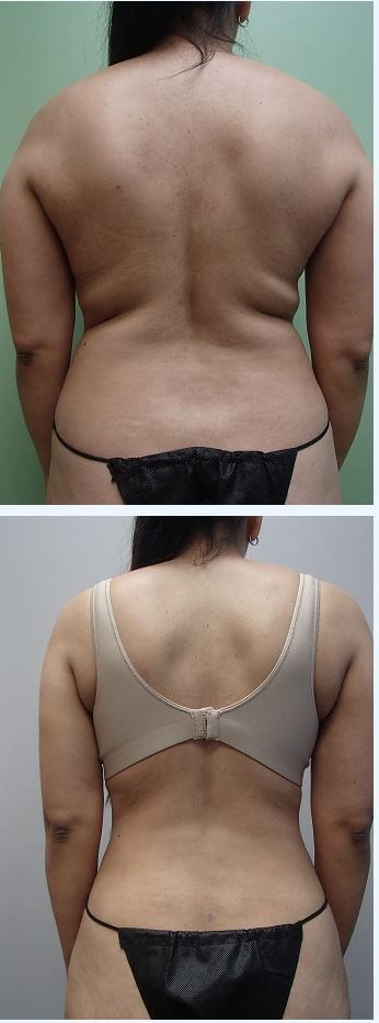 Liposuction Before