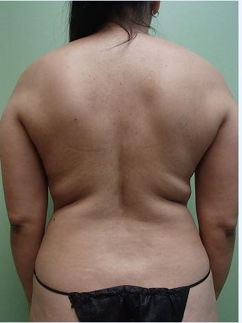 Liposuction Before
