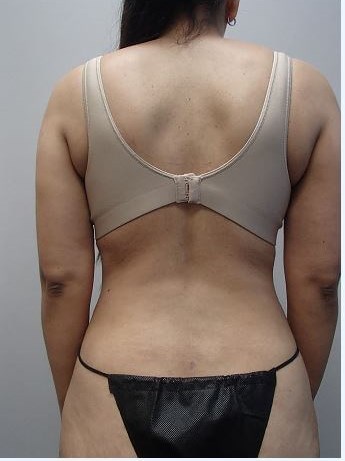 Liposuction After