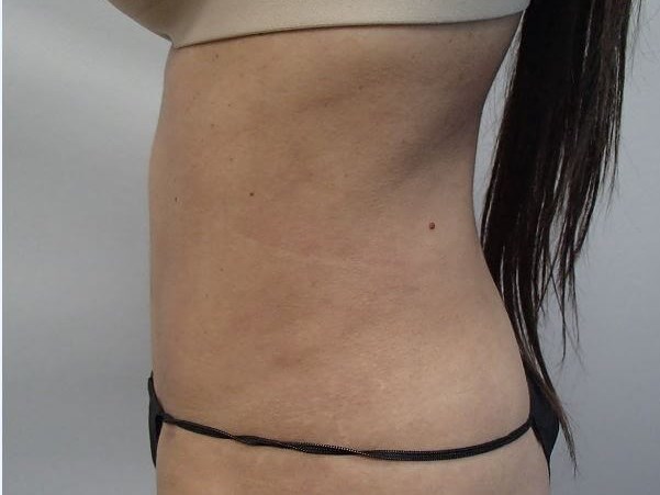 Liposuction After