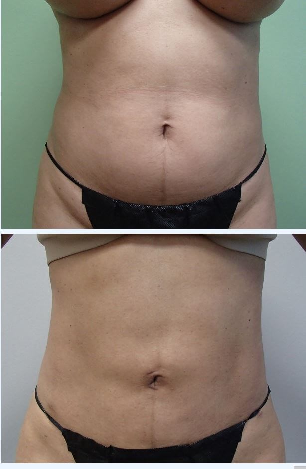 Liposuction Before