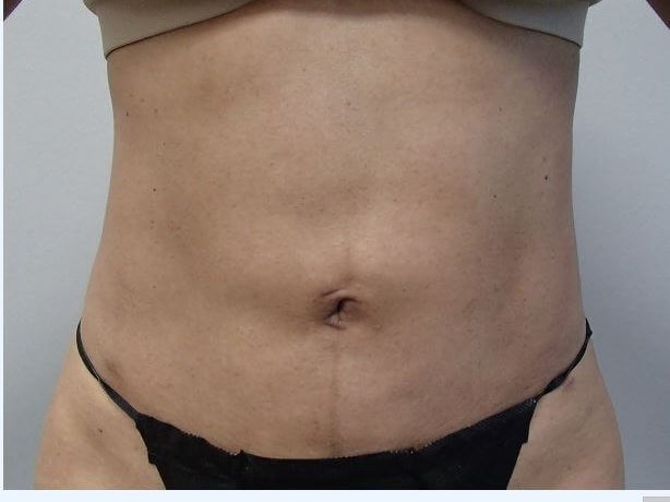 Liposuction After