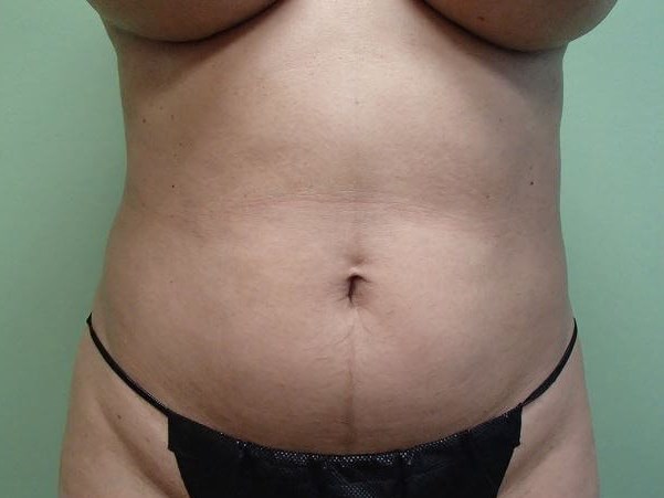Liposuction Before