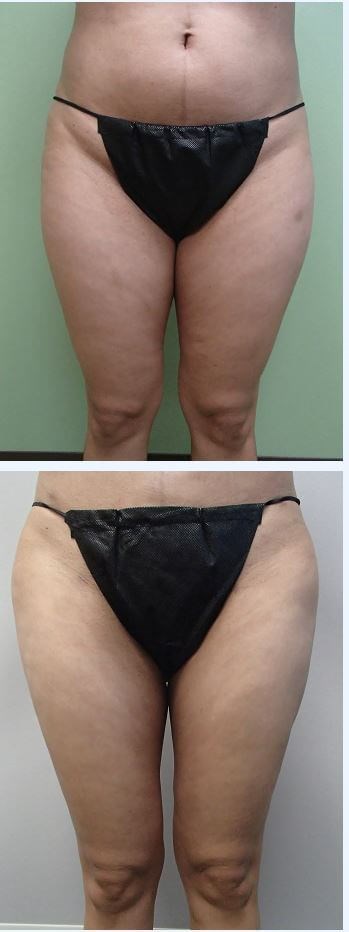 Liposuction Before