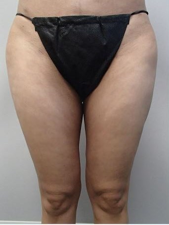 Liposuction After