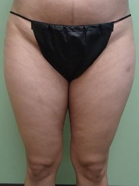 Liposuction Before