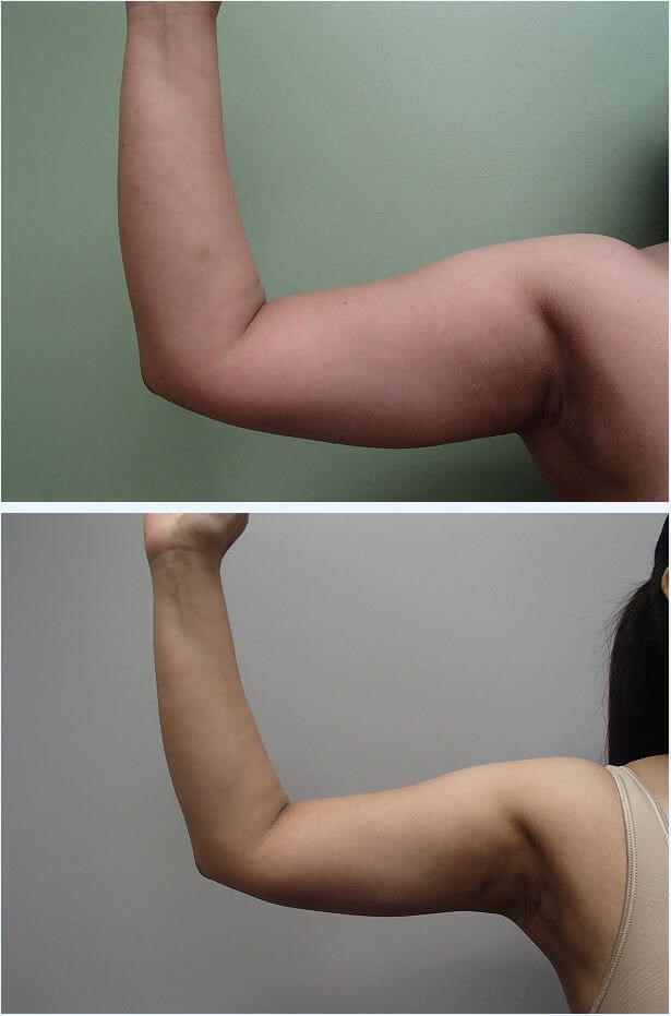 Liposuction Before