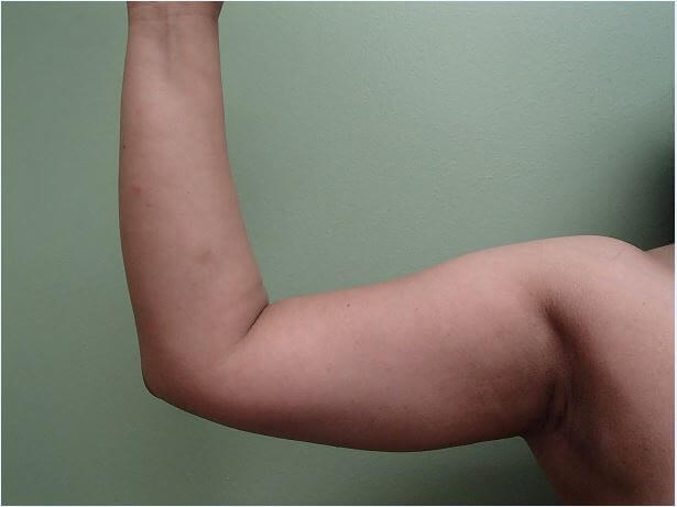 Liposuction Before
