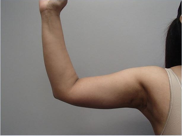 Liposuction After