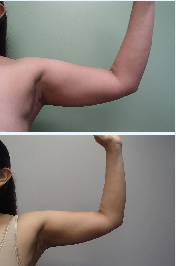 Liposuction Before