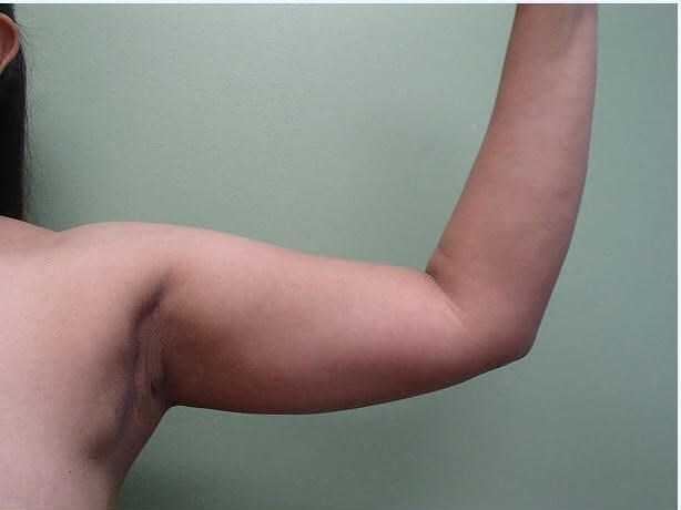 Liposuction Before