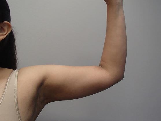 Liposuction After