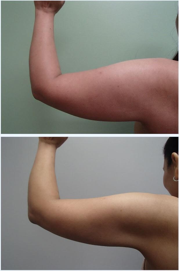 Liposuction Before