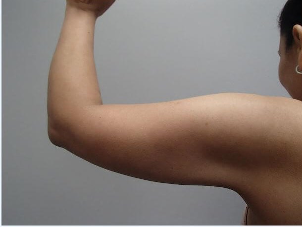 Liposuction After