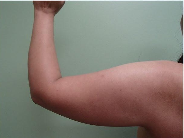 Liposuction Before