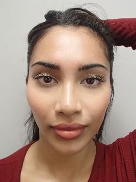 Otoplasty - Ear Surgery After