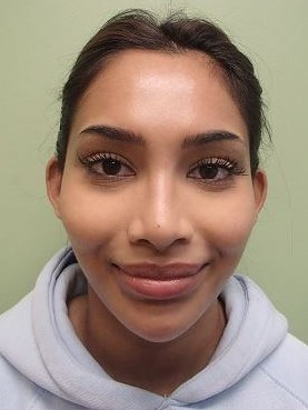Otoplasty - Ear Surgery Before