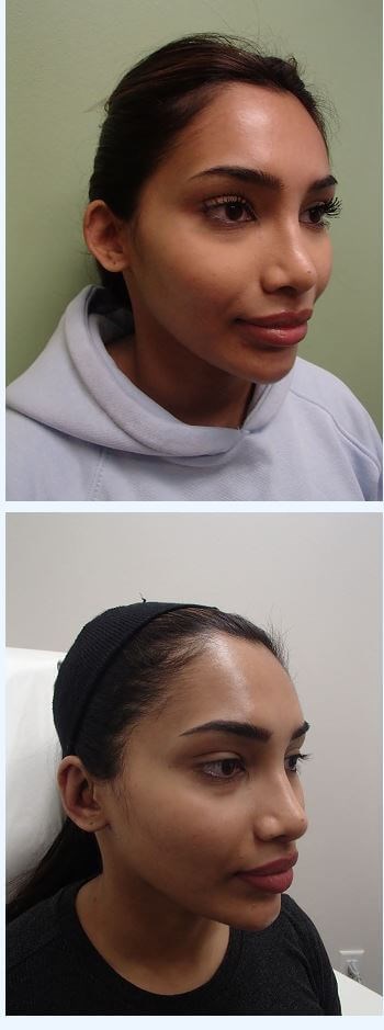 Otoplasty - Ear Surgery Before