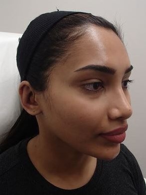 Otoplasty - Ear Surgery After