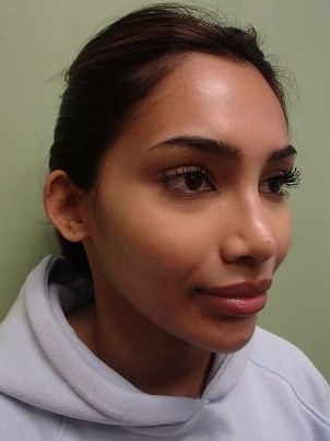 Otoplasty - Ear Surgery Before