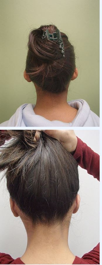 Otoplasty - Ear Surgery Before