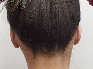 Otoplasty - Ear Surgery After