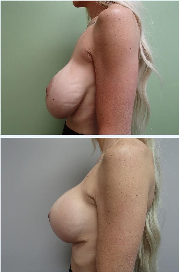 Breast Revision w/ Lift Before