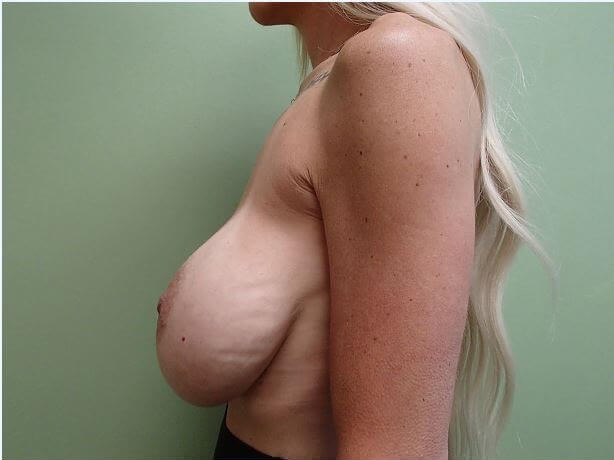 Breast Revision w/ Lift Before