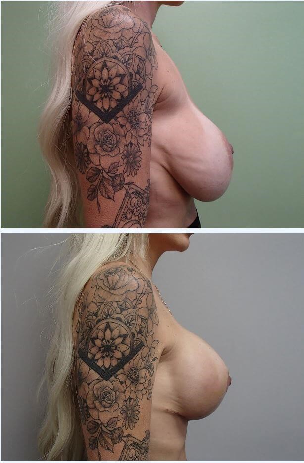 Breast Revision w/ Lift Before