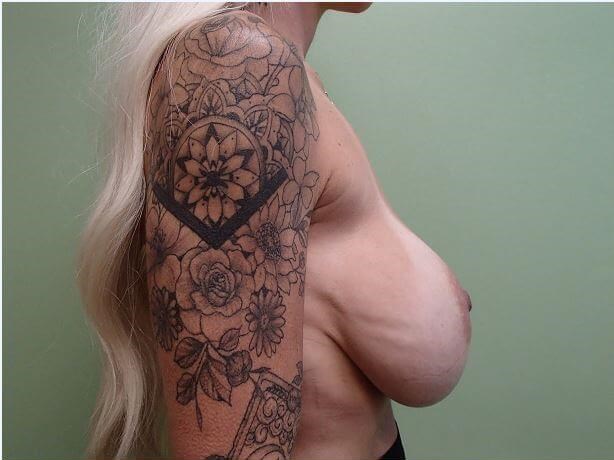Breast Revision w/ Lift Before