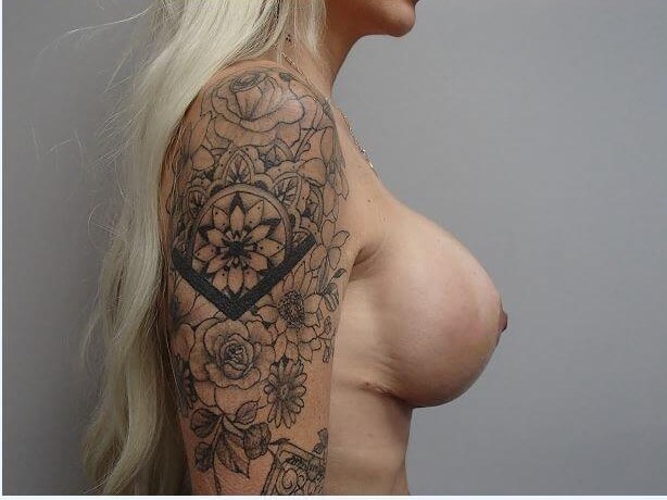Breast Revision w/ Lift After