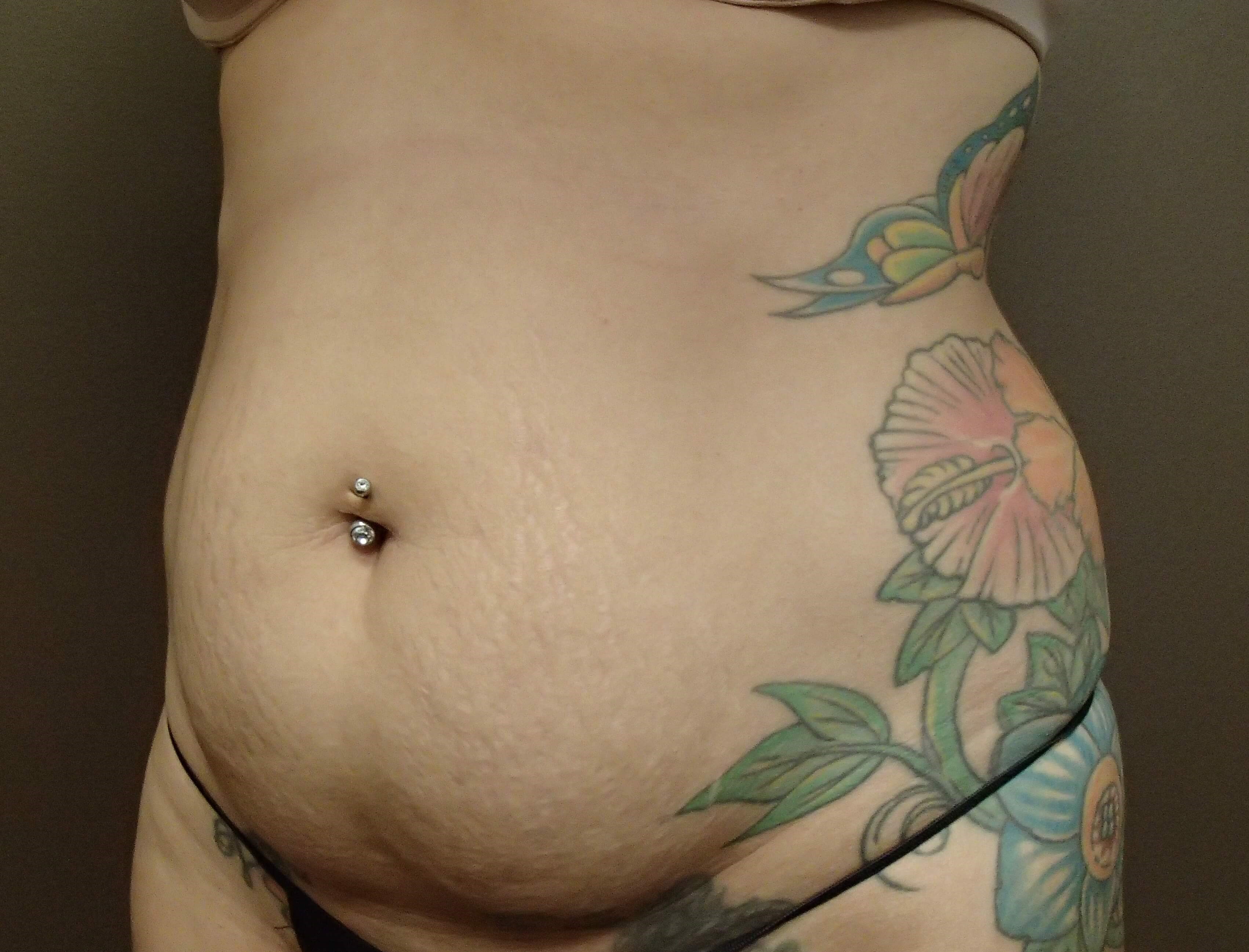 Timeless Tuck Oblique View Before
