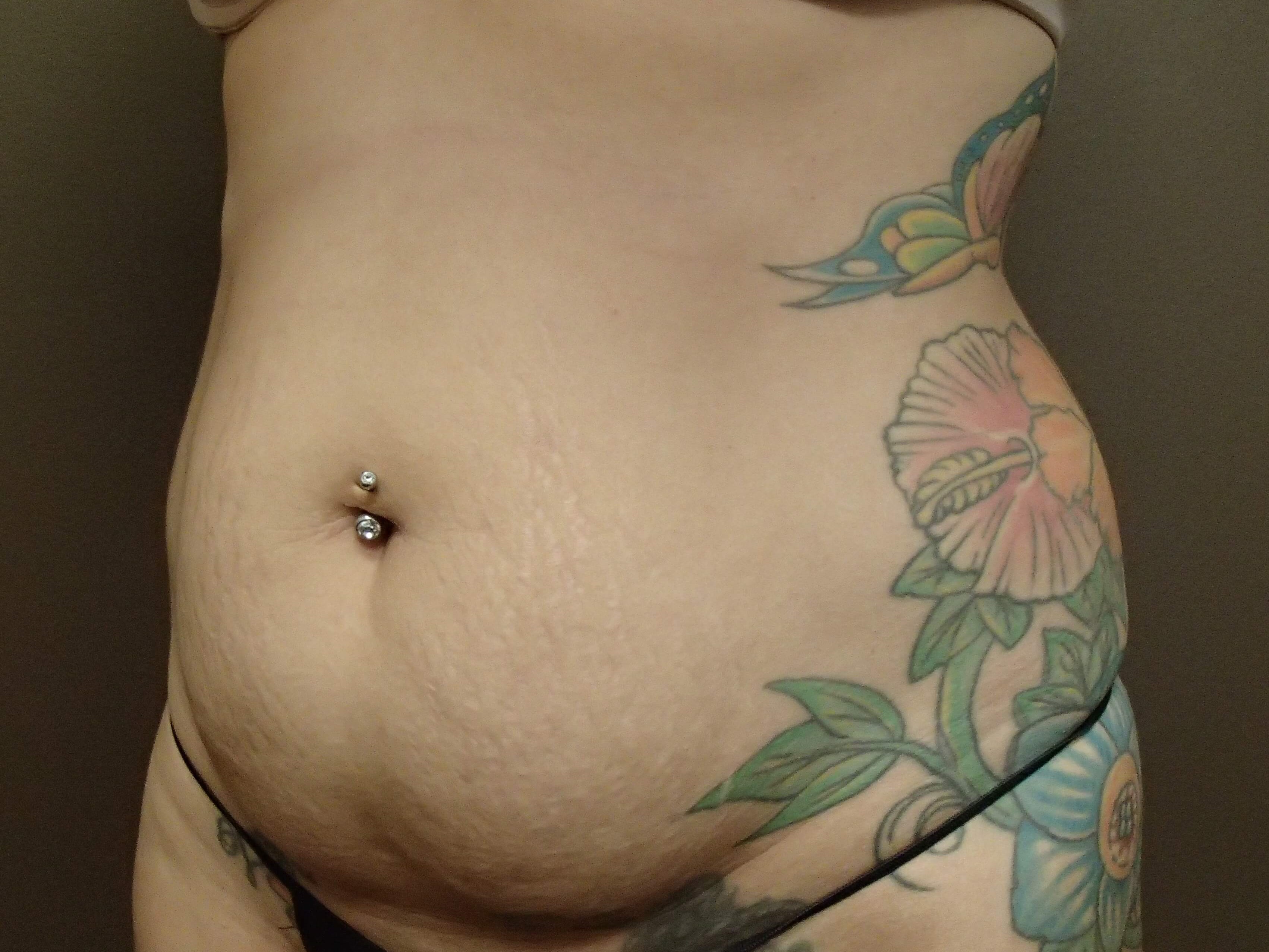 Timeless Tuck Oblique View Before
