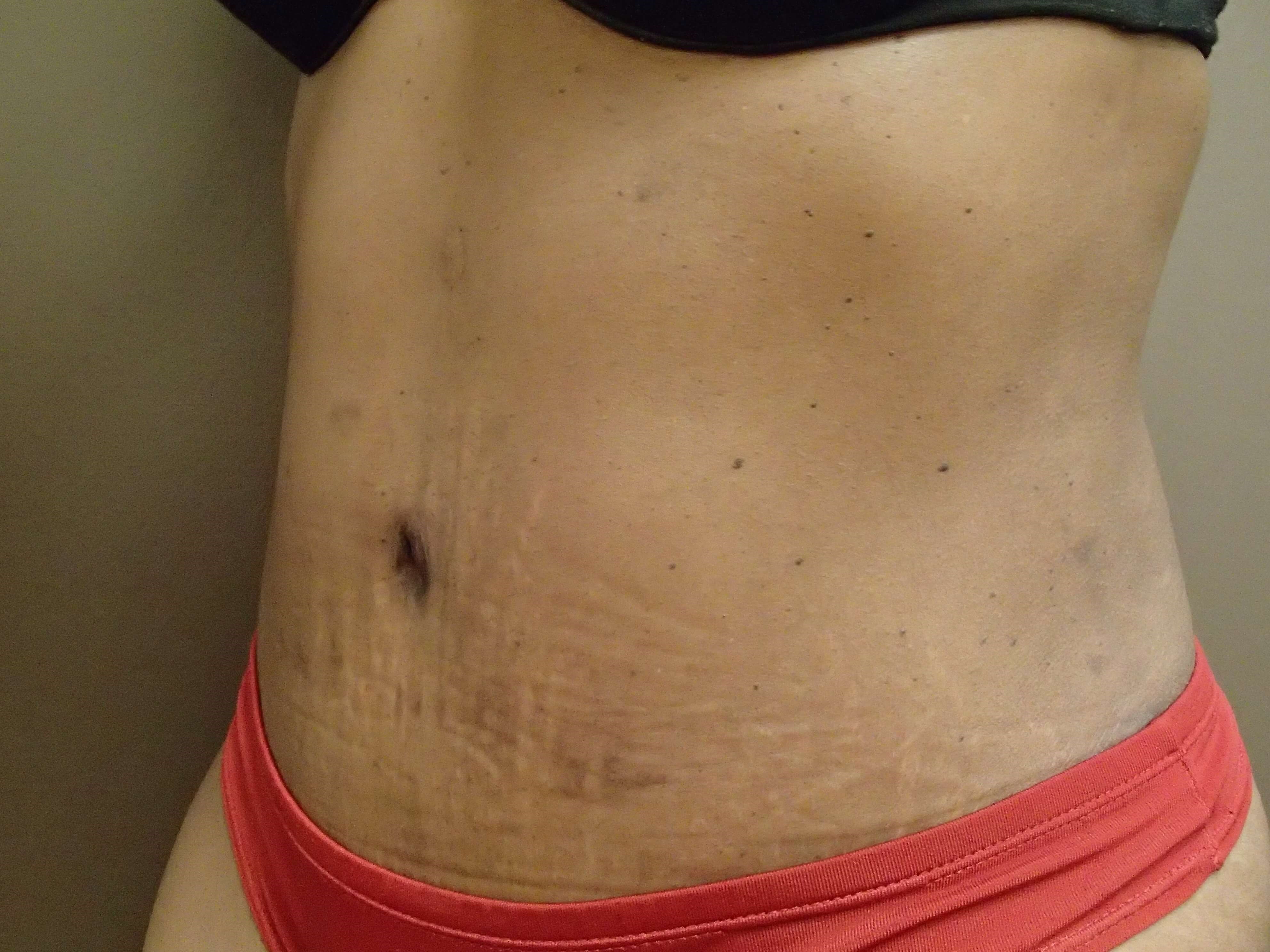Timeless Tuck Oblique View After