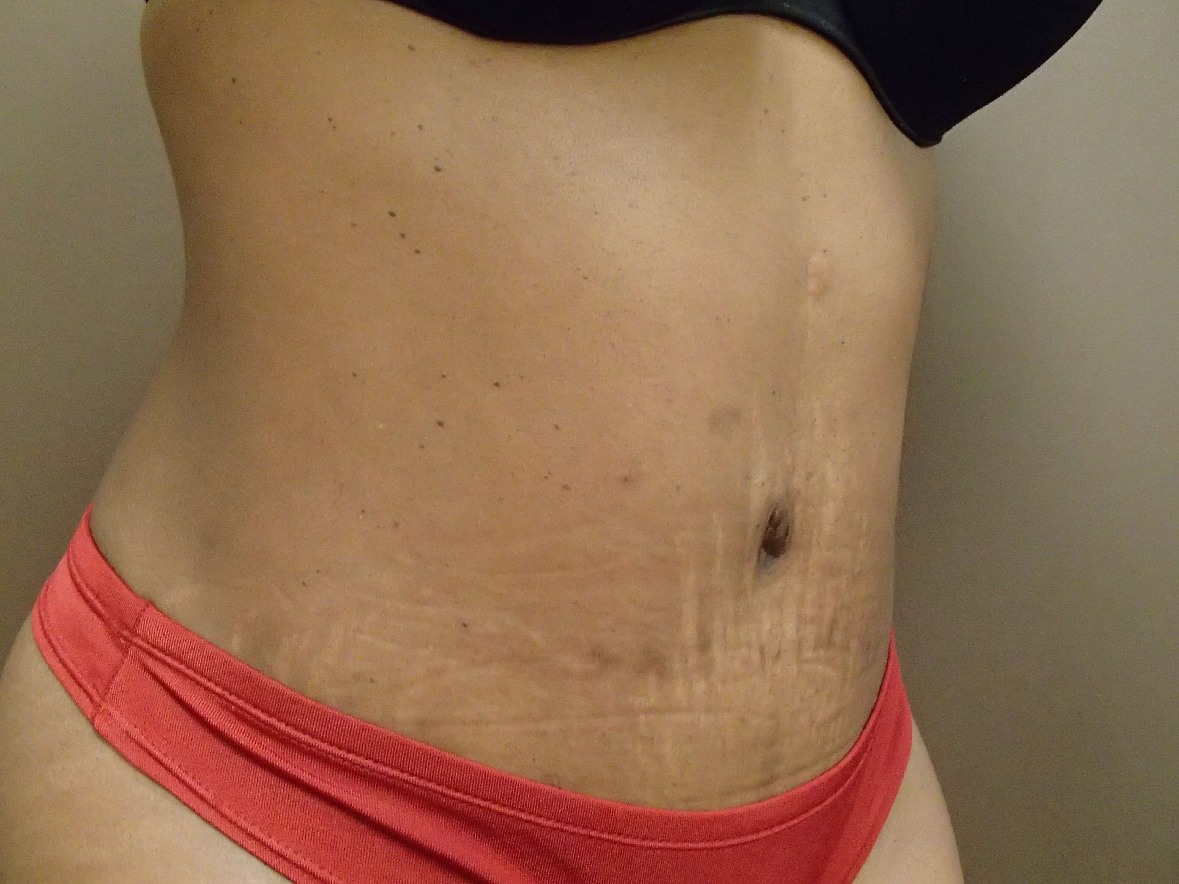 Timeless Tuck Oblique View After