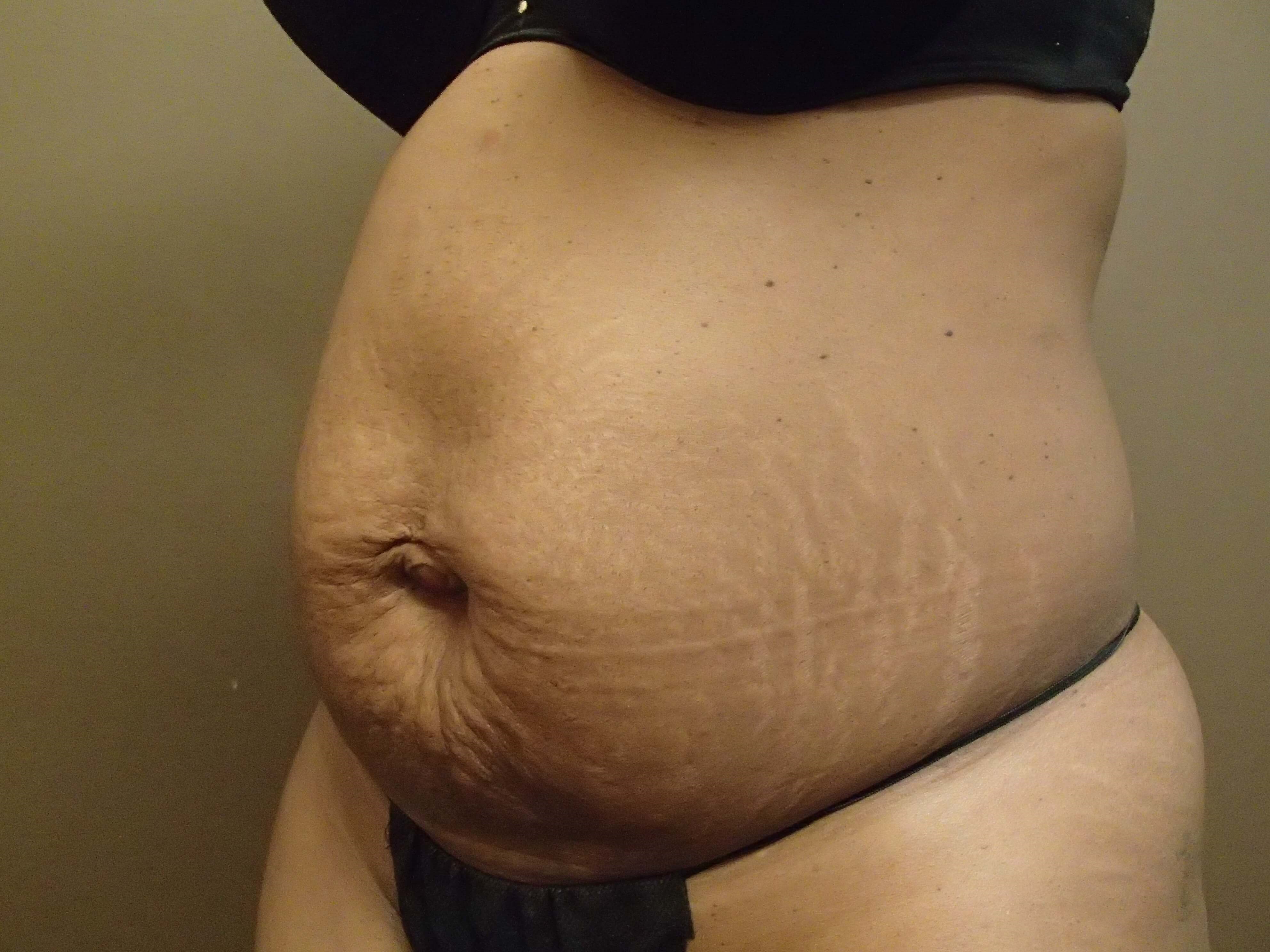 Timeless Tuck Oblique View Before