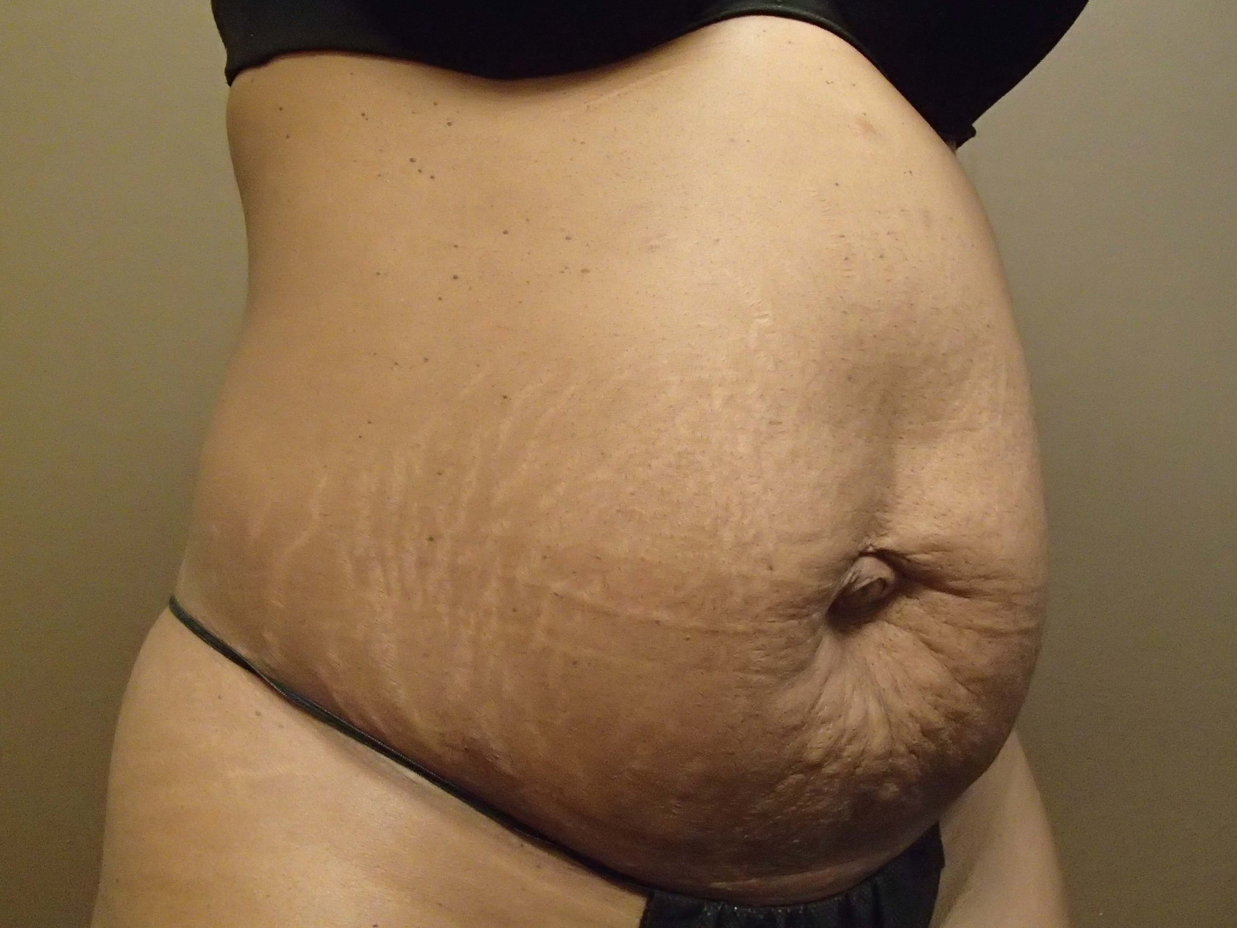 Timeless Tuck Oblique View Before