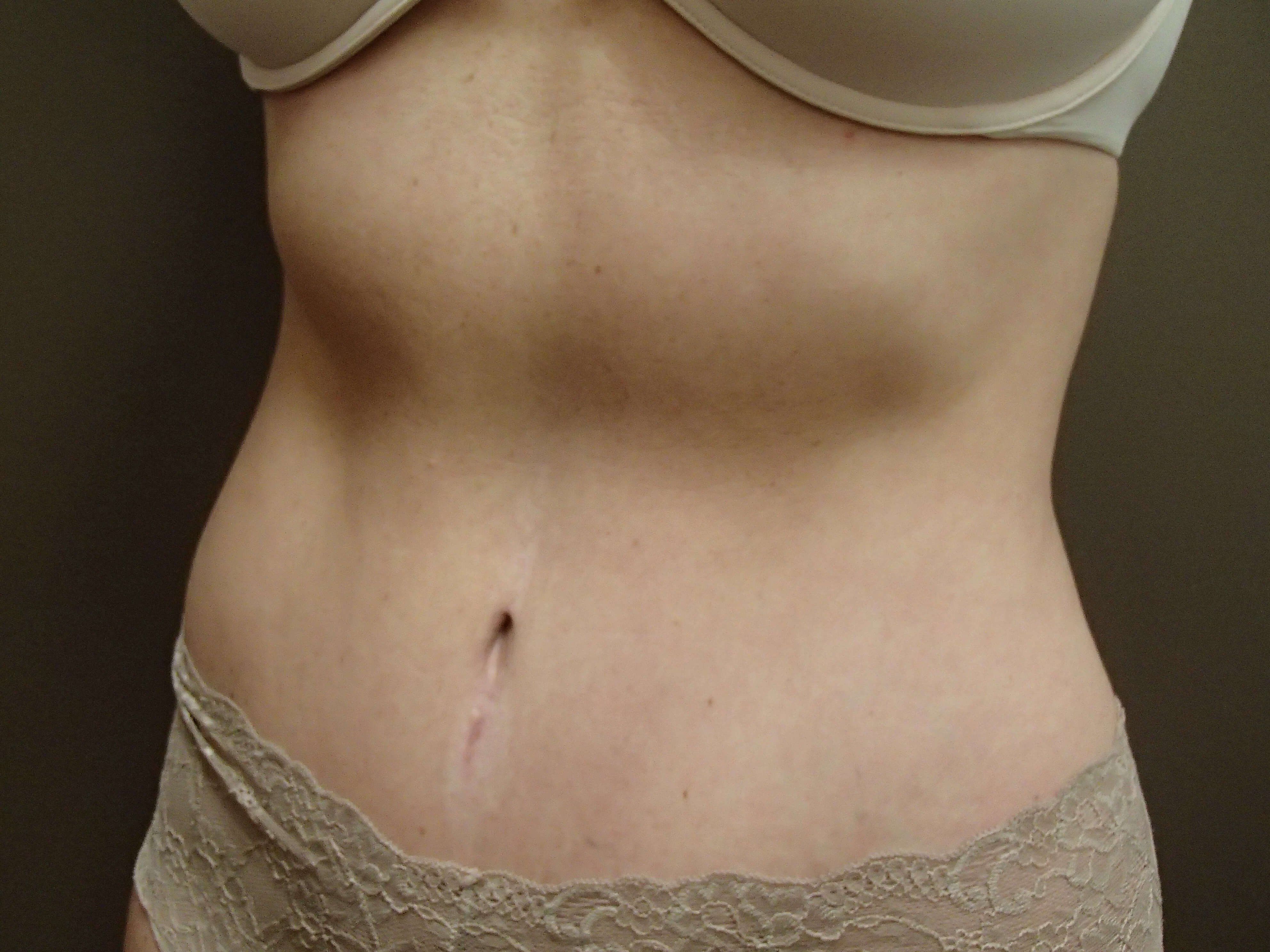 Timeless Tuck Oblique View After