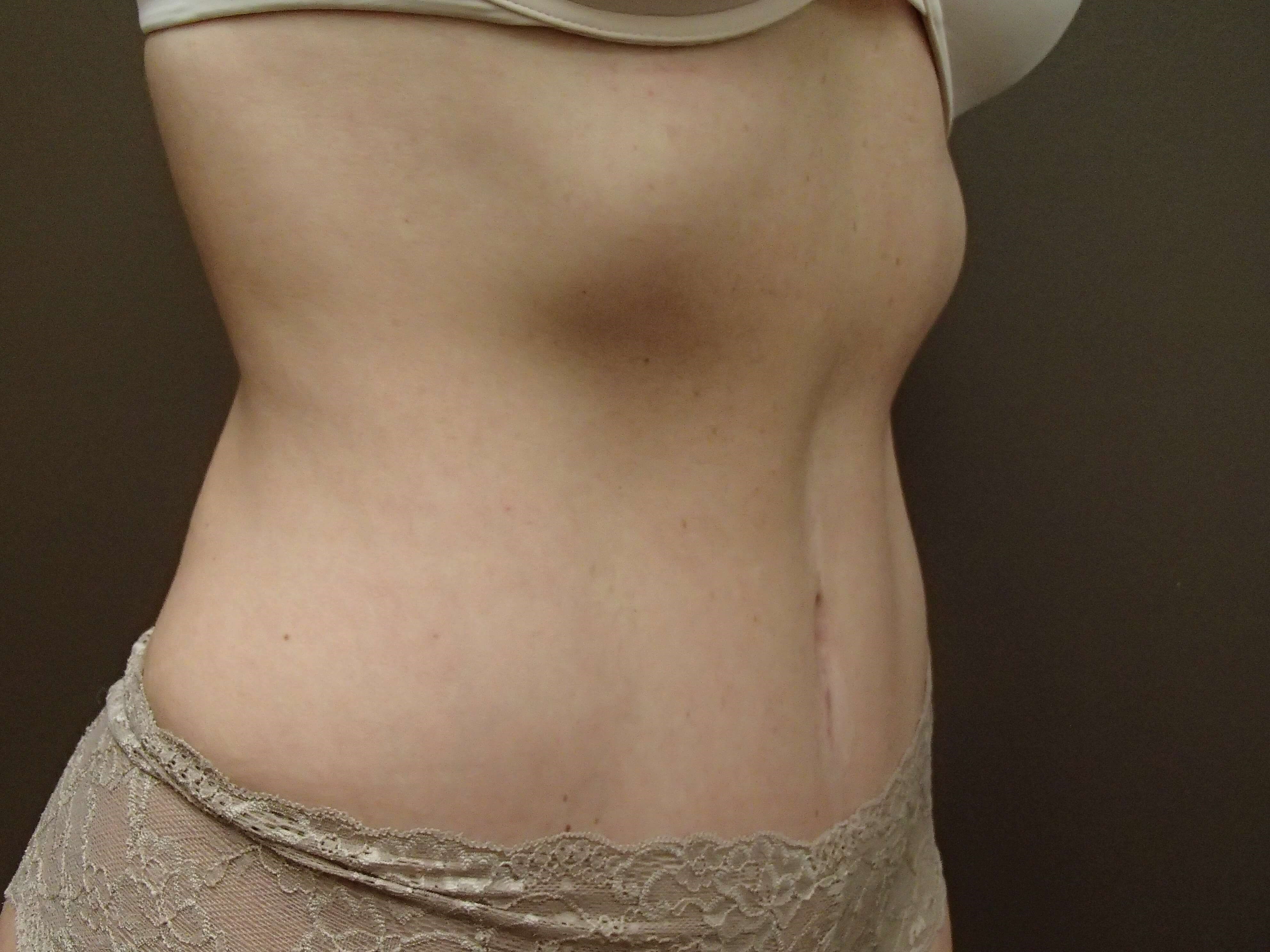 Timeless Tuck Oblique View After
