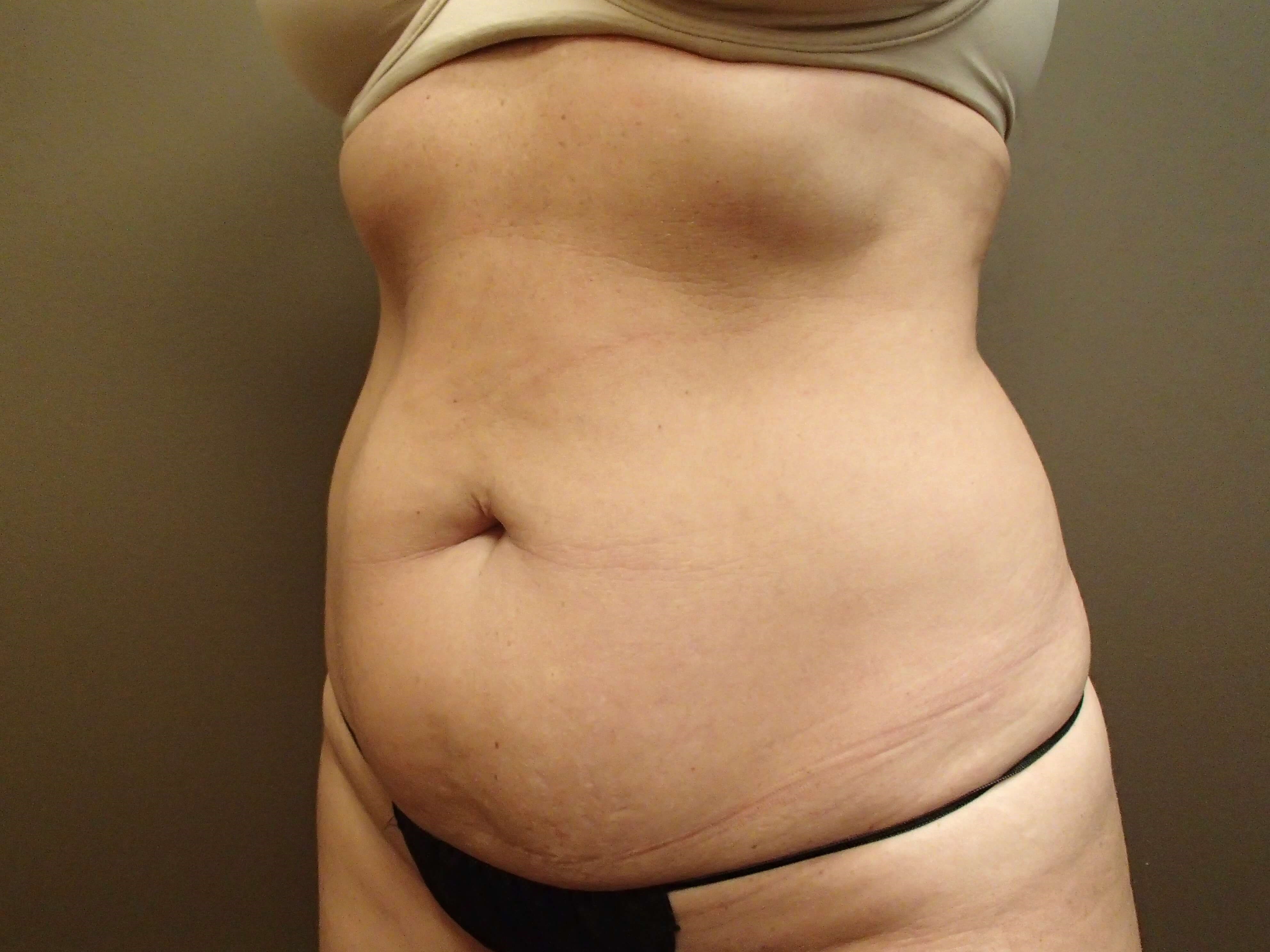 Timeless Tuck Oblique View Before