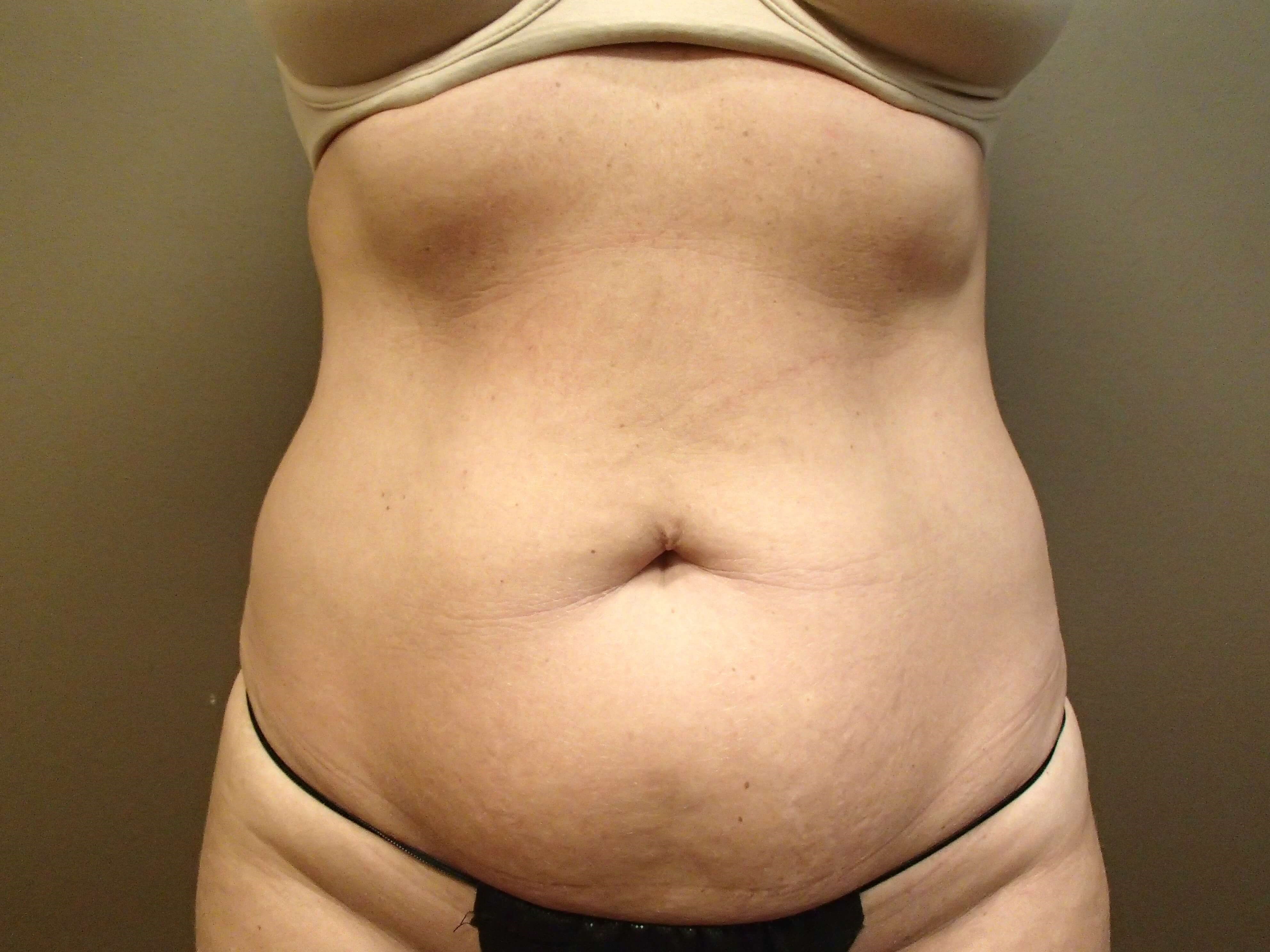 Timeless Tuck Front View Before