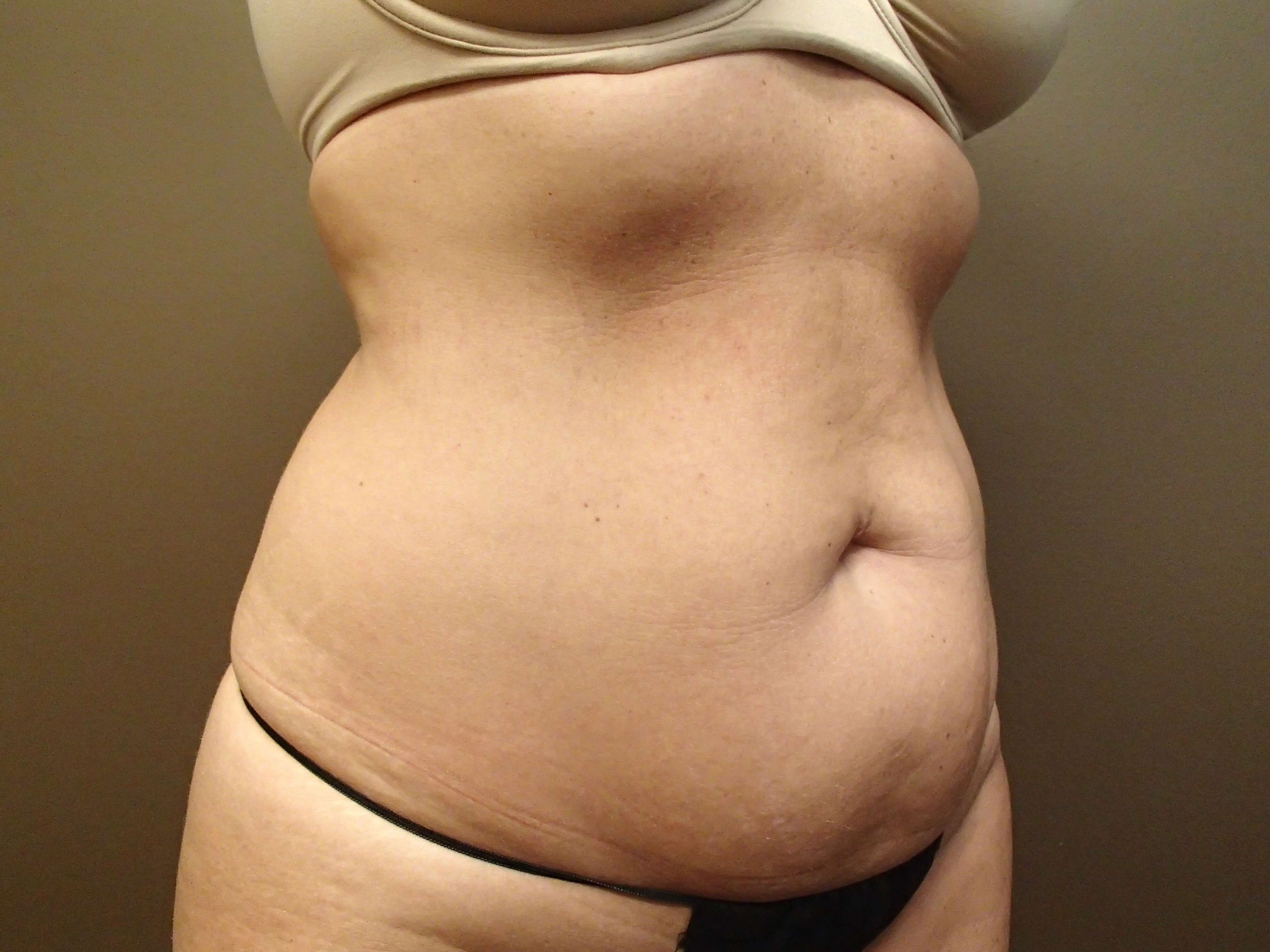 Timeless Tuck Oblique View Before